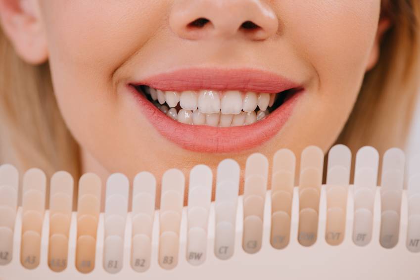 Teeth Whitening Before and After Care Tips